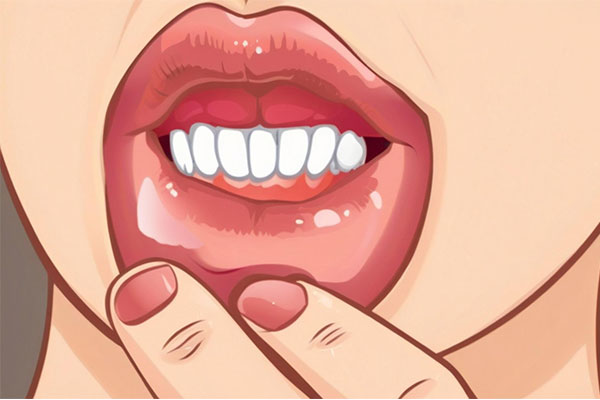 ��ǻ�Ĥ�˿�,��ǻ�Ĥ